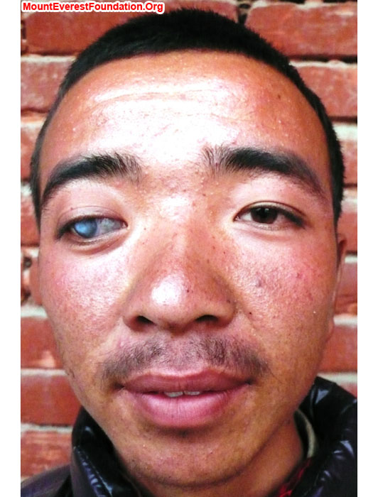 Purba Sherpa's eye was injured in a scuffle with another child when he was just 14 years old. Now our service trek has brought him to Kathmandu to see if it can be treated