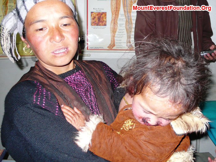 Hamu Sherpa and 2 year old daughter Nimke who we brought back from the service trek, in Dermatologist's office, during exam. Nimke has a skin infection covering her entire body.